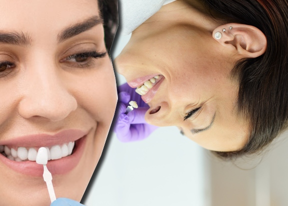 عوراض لمینت دندان دندان چیست